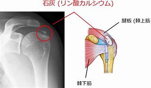 石灰沈着性肩関節周囲炎