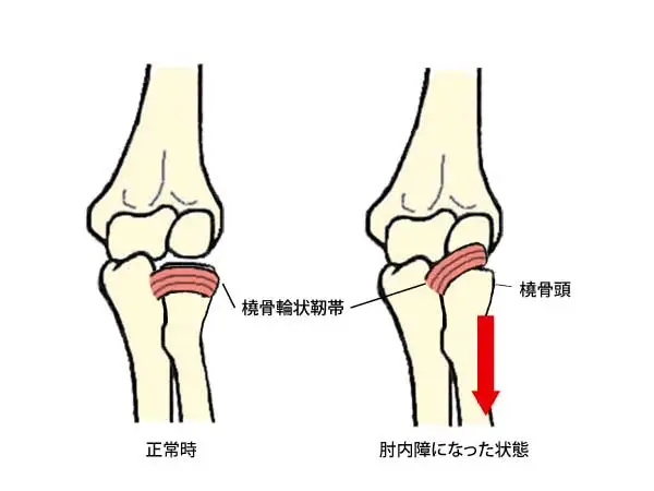 肘内障