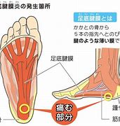 足底筋膜炎