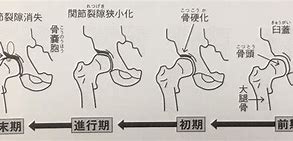 変形性股関節症　進行