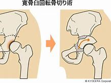 股関節骨きり術