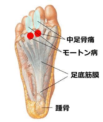 モートン病