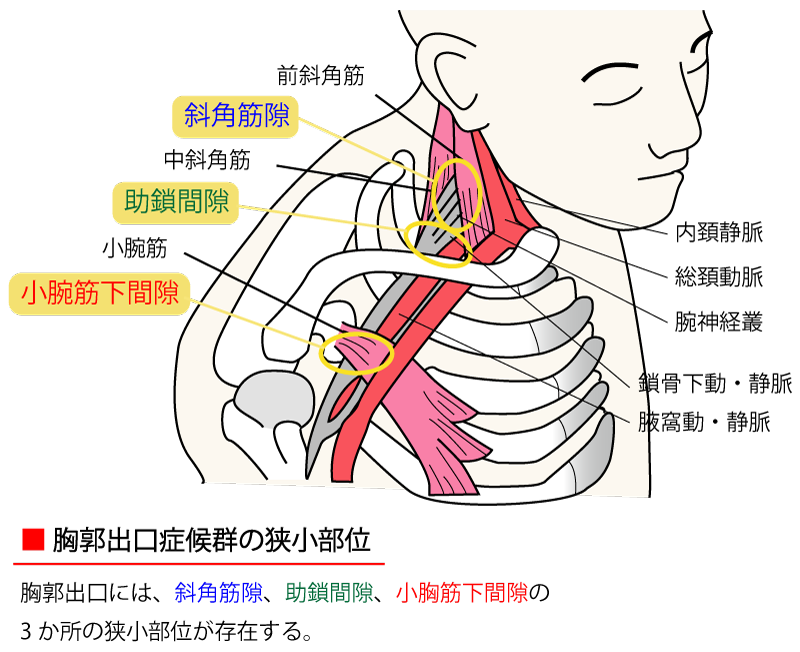 胸郭出口症候群