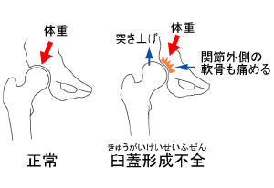 臼蓋形成不全２