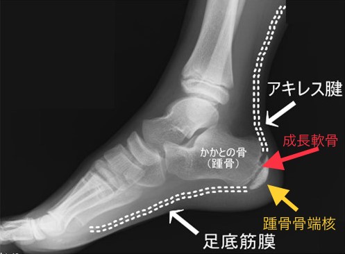 踵骨骨端炎