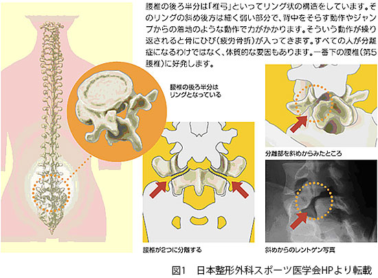 腰椎分離症