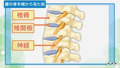 腰椎椎間板ヘルニア１