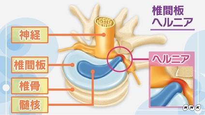 腰椎椎間板ヘルニア２