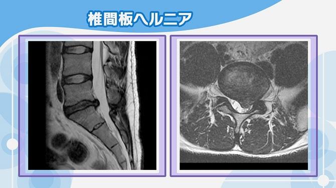 腰椎椎間板ヘルニア　MRI