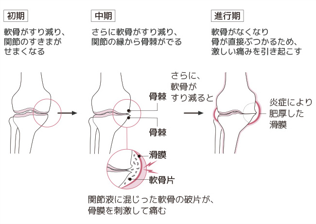 変形性膝関節症１