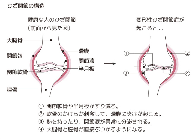 変形性膝関節症２