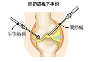 変形性膝関節症手術１