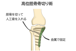 変形性膝関節症手術２