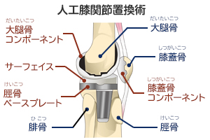 変形性膝関節症手術３