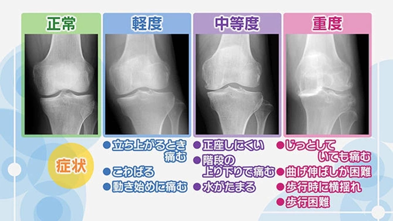 変形性膝関症４